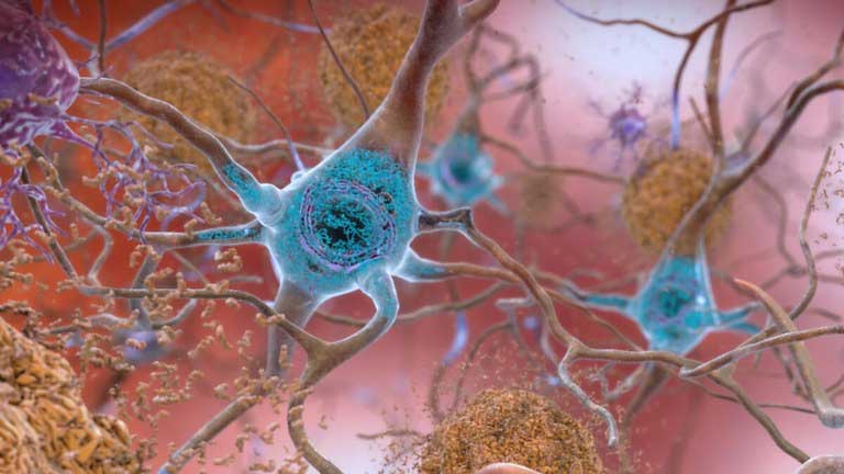 iPS researchers discover genetic traits of people prone to Alzheimer’s